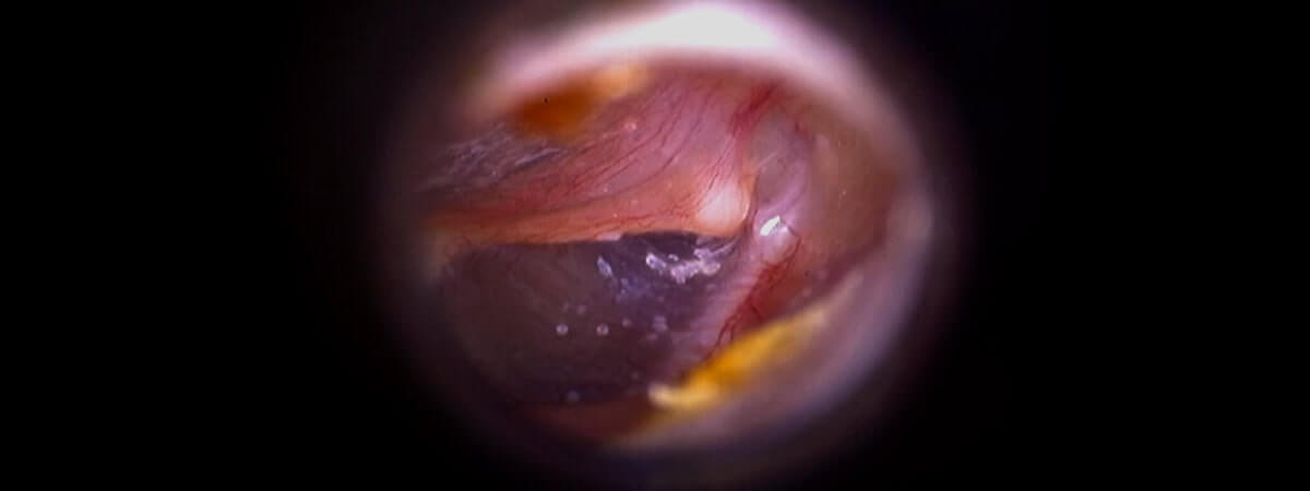 Advanced Imaging Technology-After-Taevas-endoscope